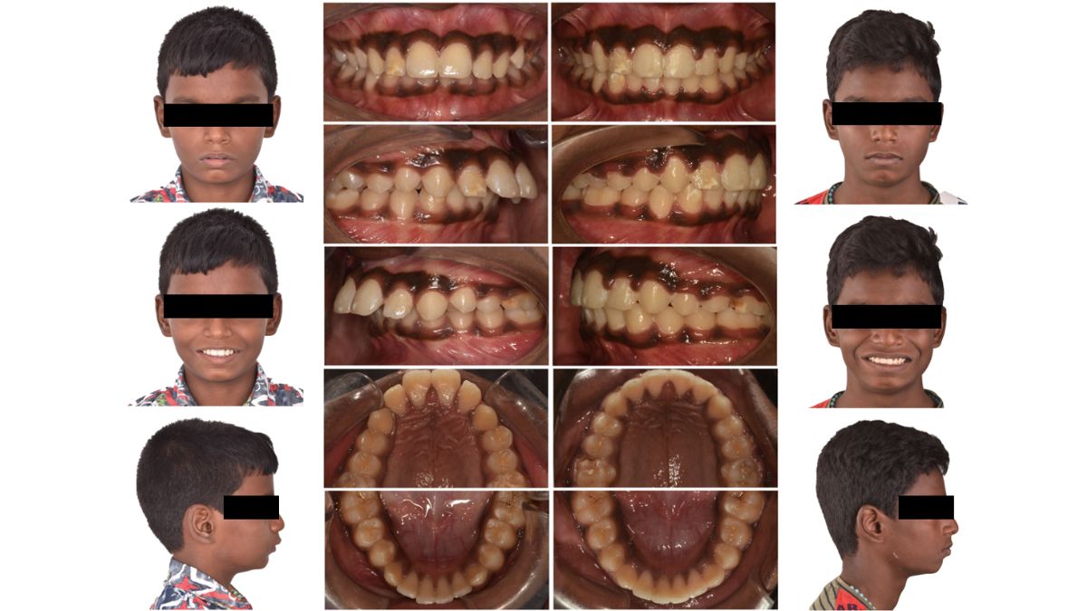 Revolutionizing Orthodontic Education and Care at Saveetha, Chennai